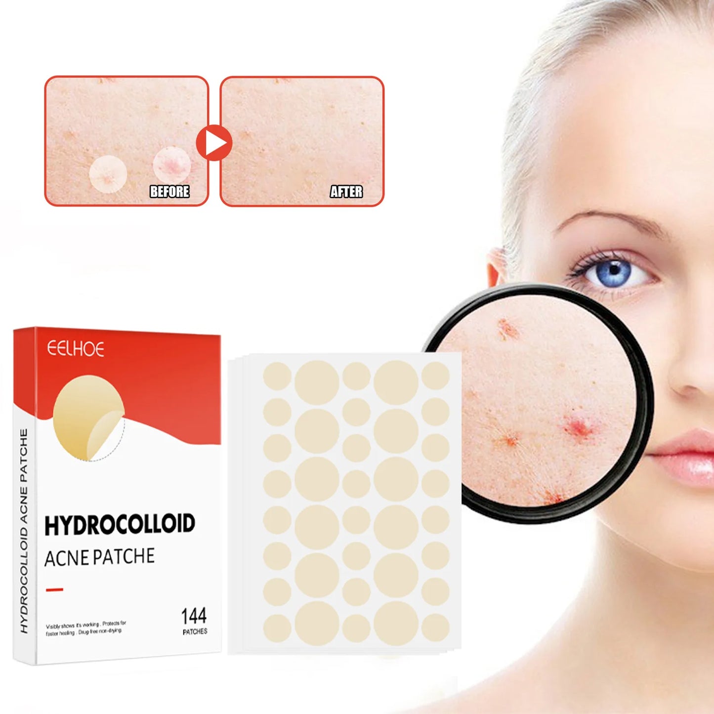 ClearDot™ 💧✨ – Invisible Acne Pimple Patch Set (144pcs for Men & Women)